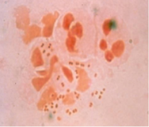 Peds Fig 1 STD -gramstain