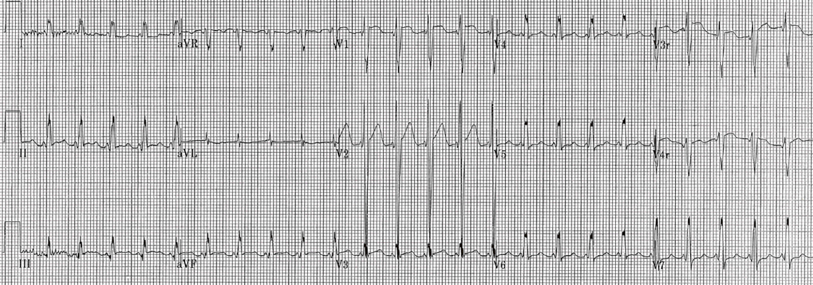 Peds Fig 2 Rhythm Interp -wpw