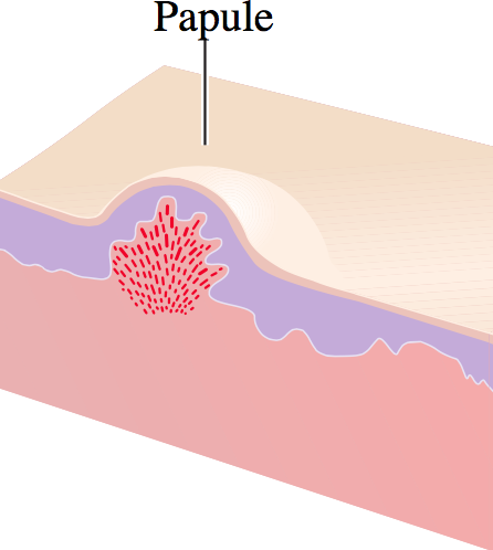 Peds Fig 3 Derm -papule