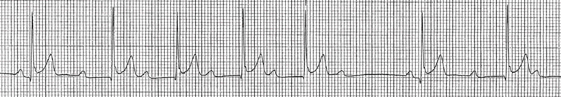 Peds Fig 3 Rhythm Interp -wenckebach