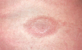 pityriasis-rosea-26