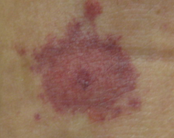Sjs Target Rash Dermatology