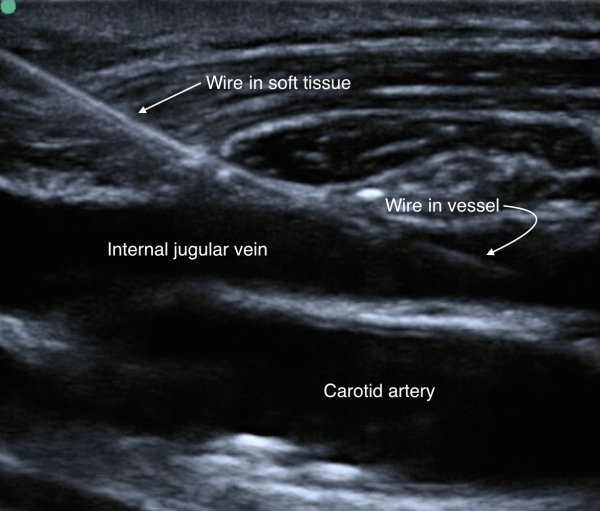 venous-access-image-15