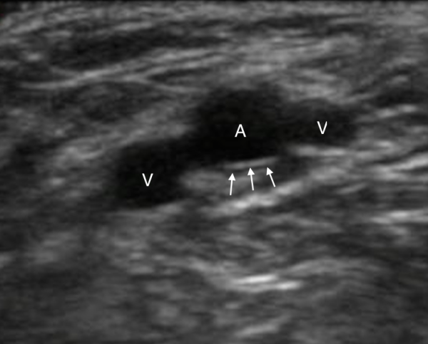 venous-access-image-2