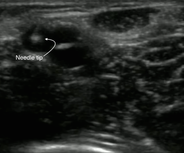 venous-access-image-7