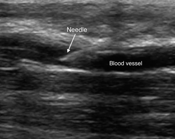 venous-access-image-9